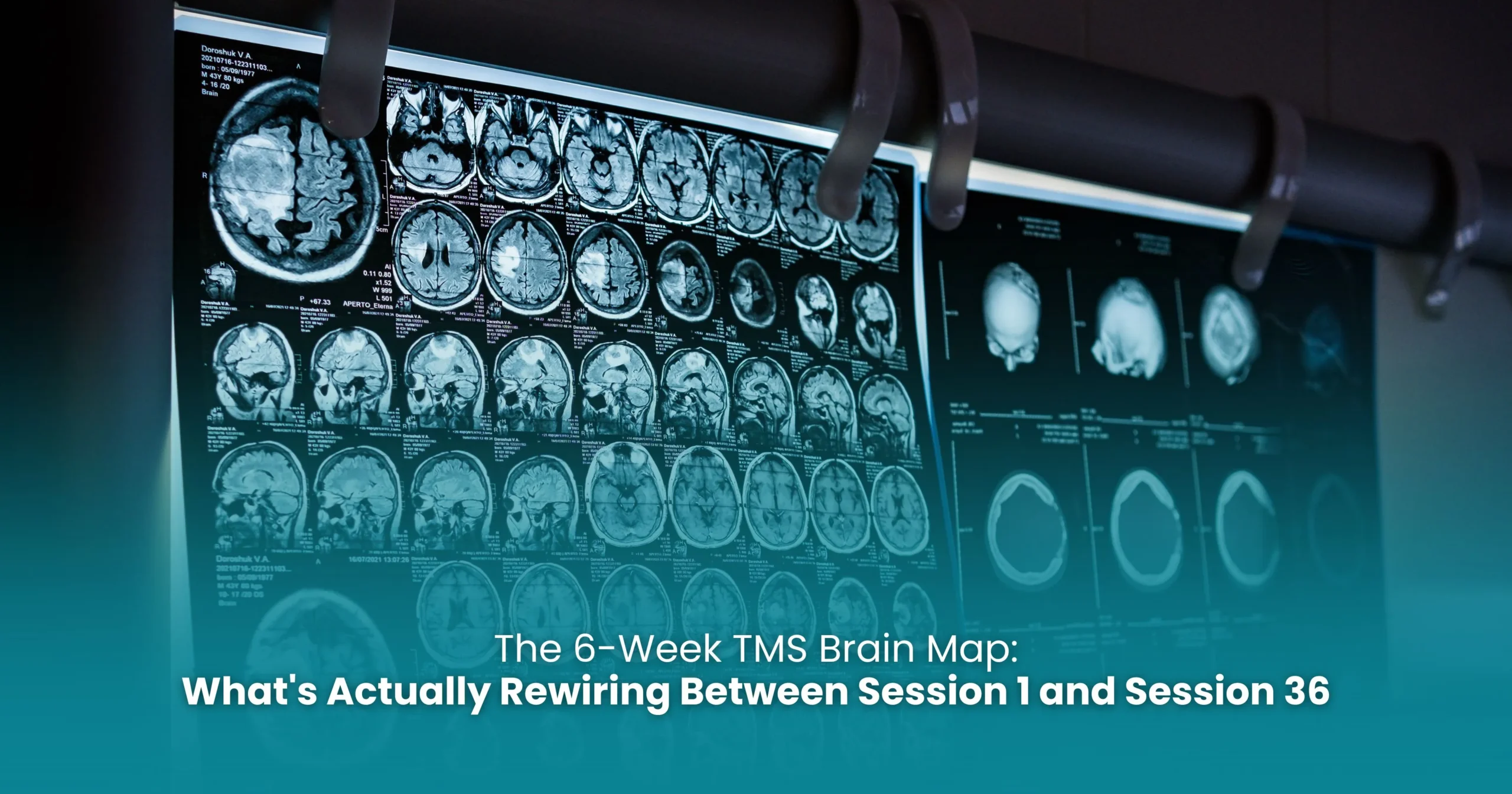 what to expect during TMS therapy